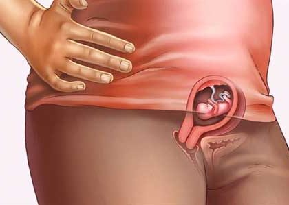 Bệnh trĩ khi mang thai hay gặp phải